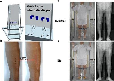 Improved angle accuracy of tibial plateau osteotomy for total knee arthroplasty using tibial mechanical axis skin-mapping